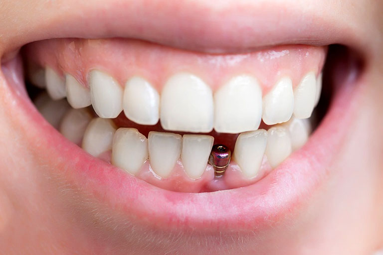 Trồng răng cửa bằng cách cấy Implant