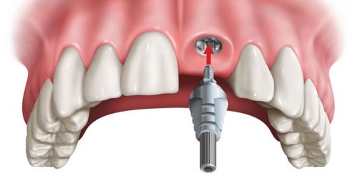 Trồng răng cửa có đau không và những lưu ý quan trọng