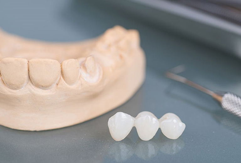 Trồng răng giả thường được chỉ định trong trường hợp mất răng