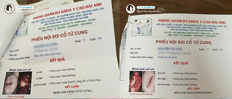 Kết quả trước và sau điều trị viêm lộ tuyến cổ tử cung với bài thuốc Diệp Phụ Khang