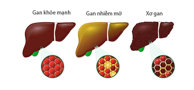 biến chứng của bệnh gan nhiễm mỡ không do rượu