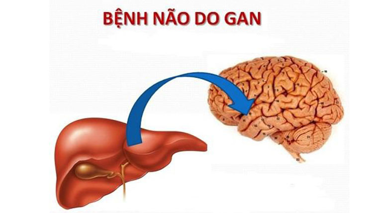 Hội chứng não gan là gì