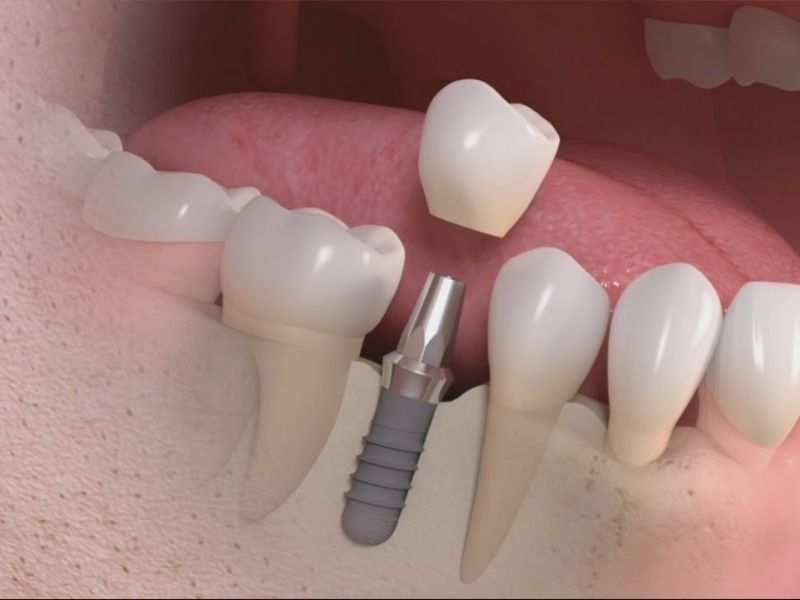 Trồng răng là dịch vụ thẩm mỹ theo yêu cầu không được hưởng BHYT