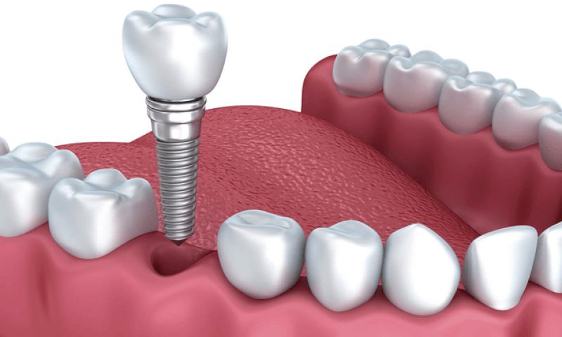 Cấy ghép Implant là phương pháp phục hình nha nha khoa tối ưu nhất hiện nay