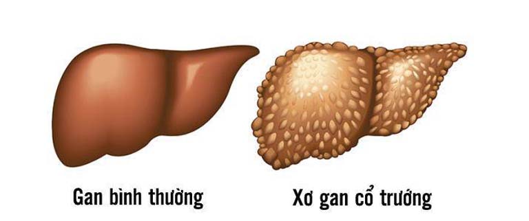 Xơ gan cổ trướng có chữa khỏi được không? 