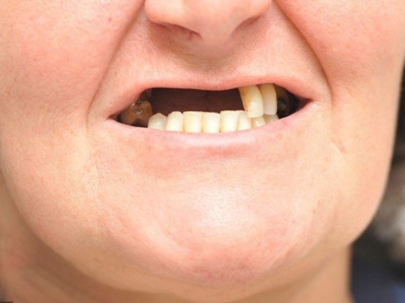 Nhổ răng không trồng lại gây nên nhiều ảnh hưởng đến sức khỏe và thẩm mỹ
