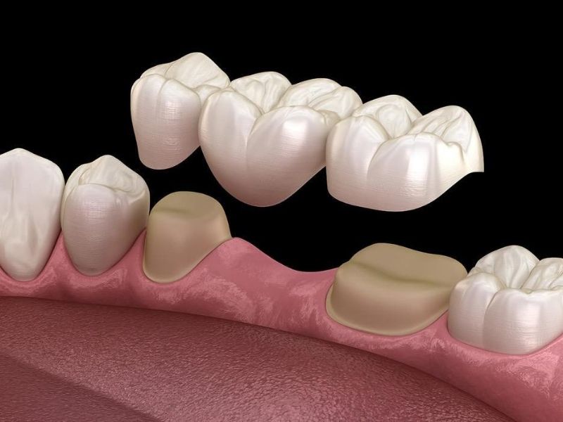 Cầu sứ gắn cố định lên răng vì thế việc vệ sinh cũng đơn giản như răng thật