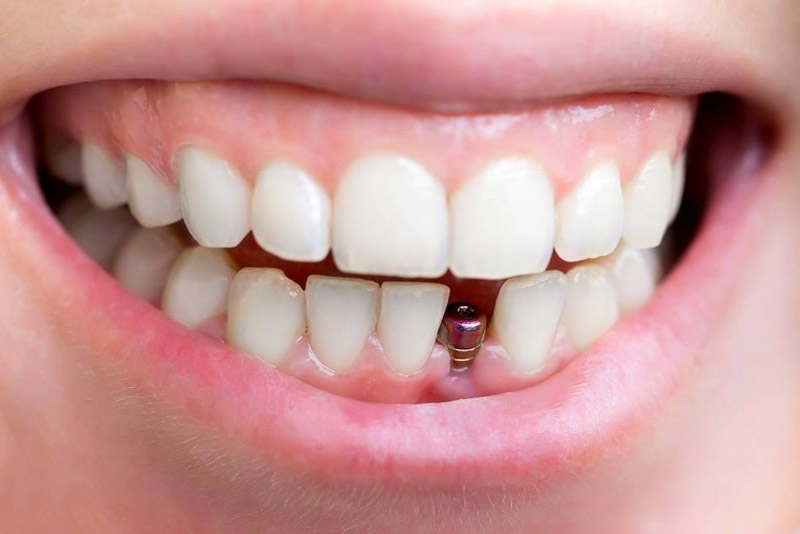 Việc trồng răng cố định không gây nguy hiểm đến sức khỏe