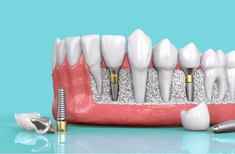 Số lượng răng cần trồng mới sẽ quyết định mức độ đau