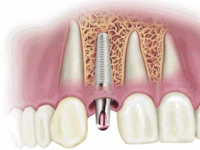 Trồng răng Implant không đúng kỹ thuật gây ra nhiều biến chứng