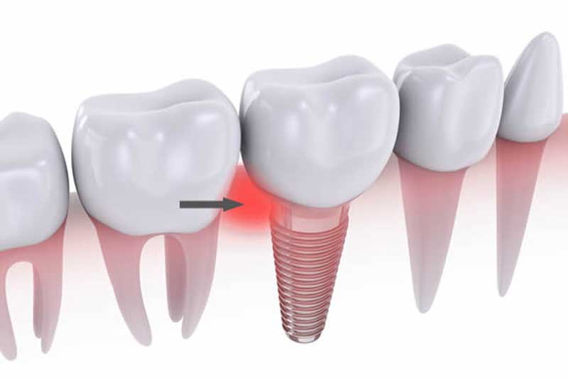 Viêm quanh trụ Implant là biến chứng thường gặp sau phẫu thuật