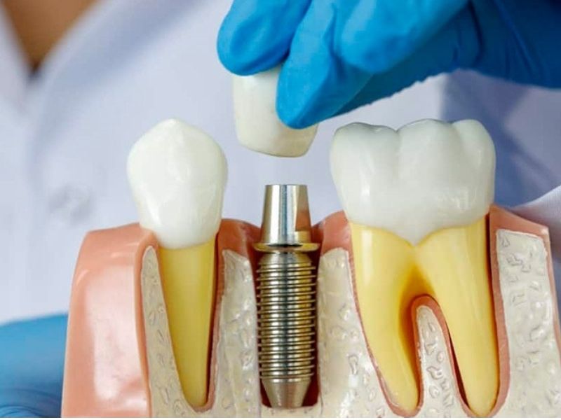 Trồng răng implant có nguy hiểm không? Kỹ thuật này không gây hại sức khỏe