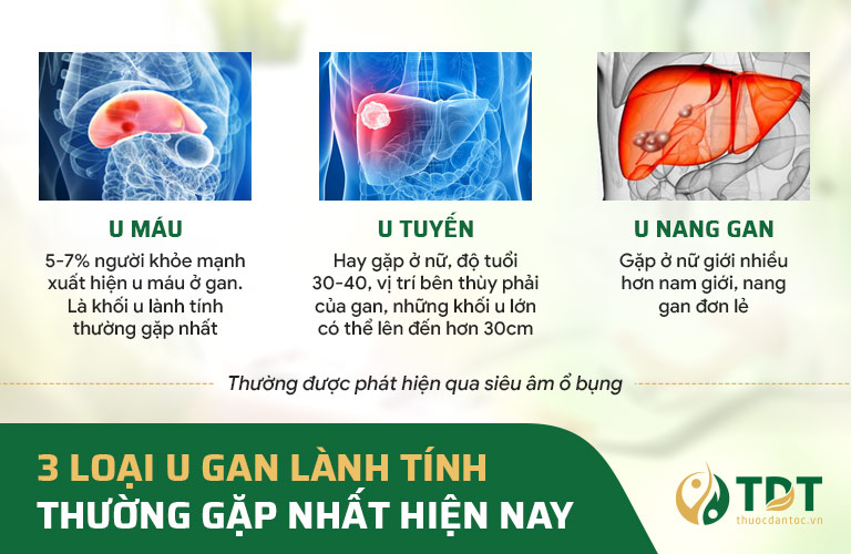 các loại u gan lành tính