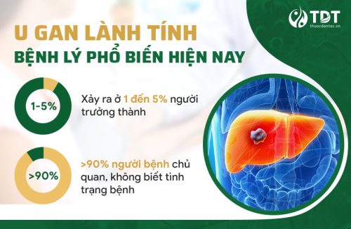 U gan lành tính - Căn bệnh khiến nhiều người chủ quan