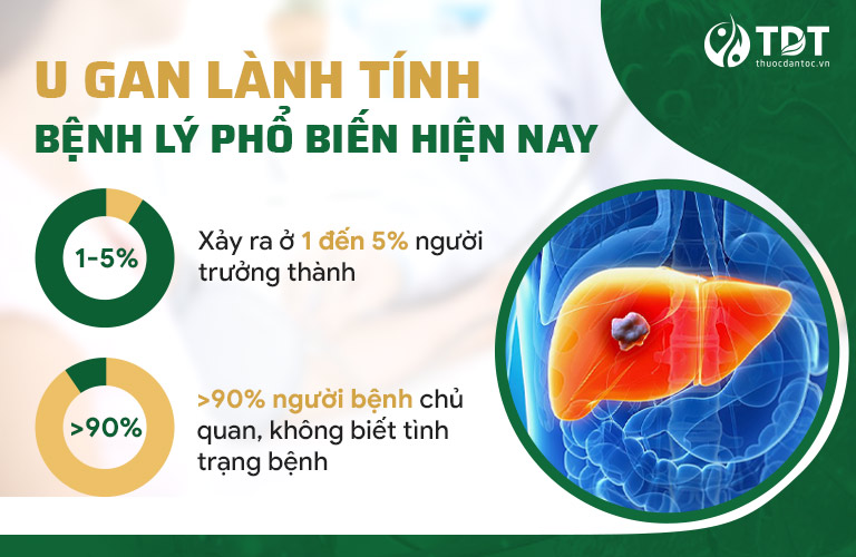 U gan lành tính là gì