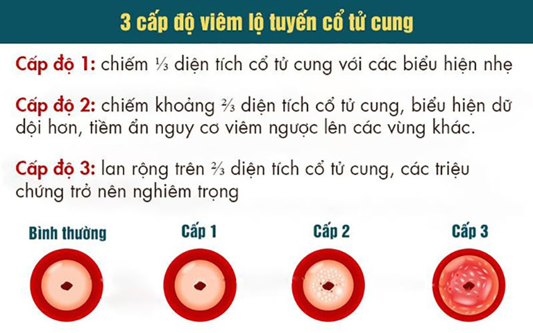 Các cấp độ viêm lộ tuyến cổ tử cung