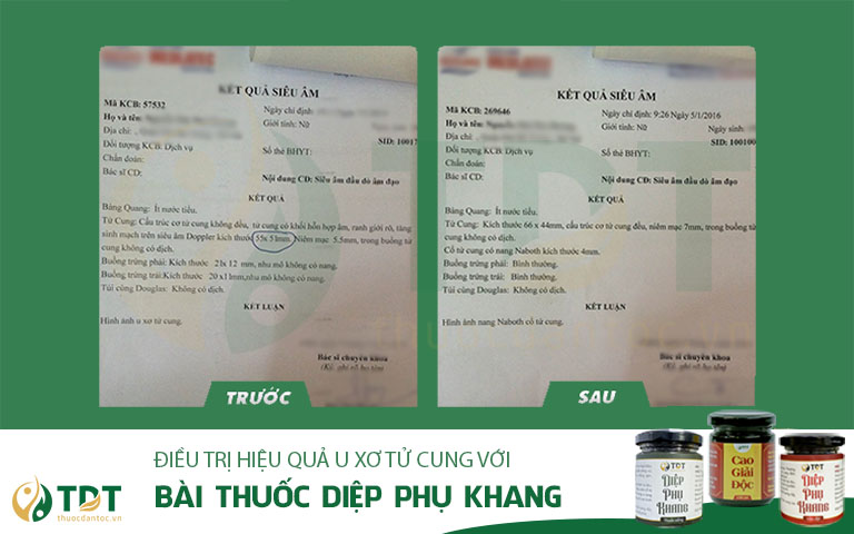 Kết quả siêu âm cho thấy sự cải thiện của u xơ tử cung sau khi điều trị với Diệp Phụ Khang