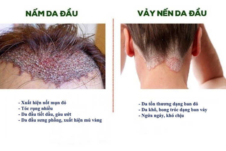 Phân biệt vảy nến da đầu nấm da đầu