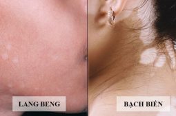 Phân Biệt Bạch Biến và Lang Ben - Lý Giải Từ Chuyên Gia