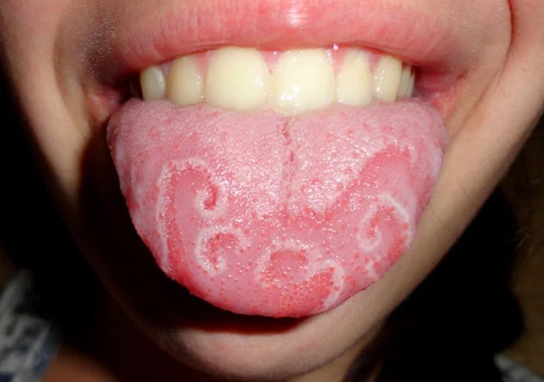 Viêm lưỡi bản đồ cũng có thể gây ra tình trạng khô miệng rát lưỡi