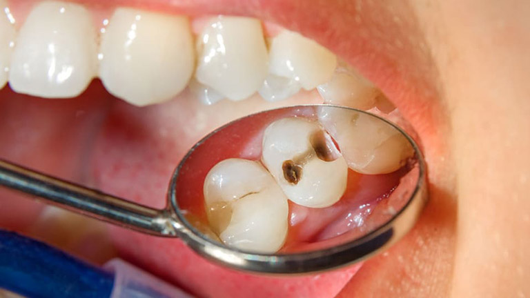 Trám răng có bị hôi miệng không?