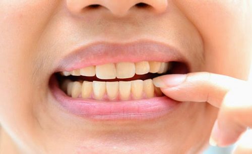 Viêm nha chu có chữa được không?