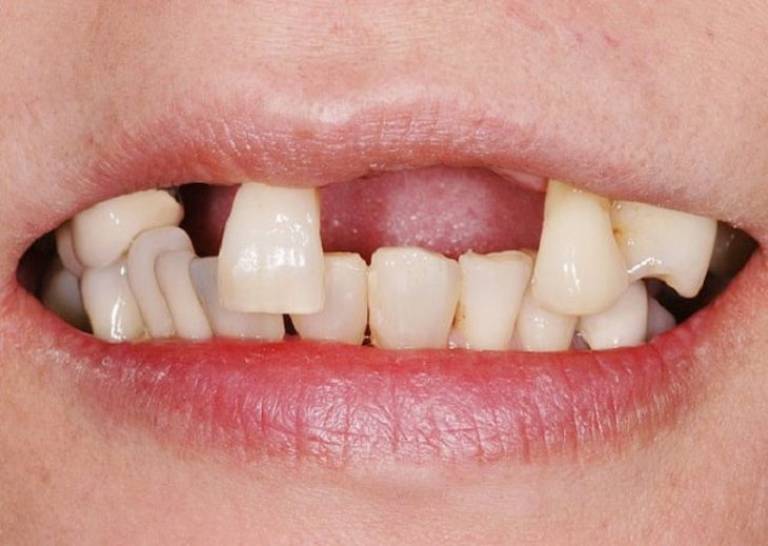 Viêm nha chu mãn tính gây mất răng