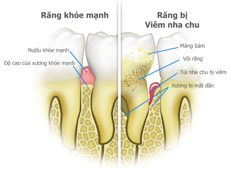 Viêm nha chu được chẩn đoán qua các triệu chứng lâm sàng và đầu dò nha khoa