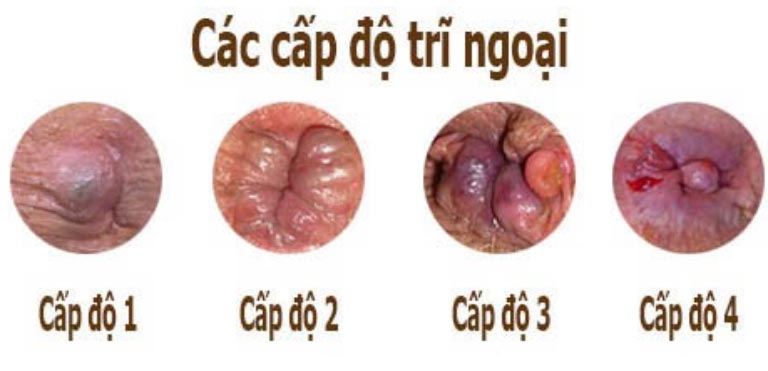 các cấp độ của bệnh trĩ