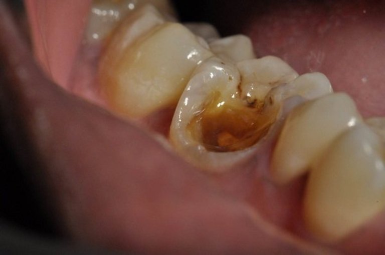 Răng số 7 bị sâu thường gây ra cảm giác đau nhức khó chịu