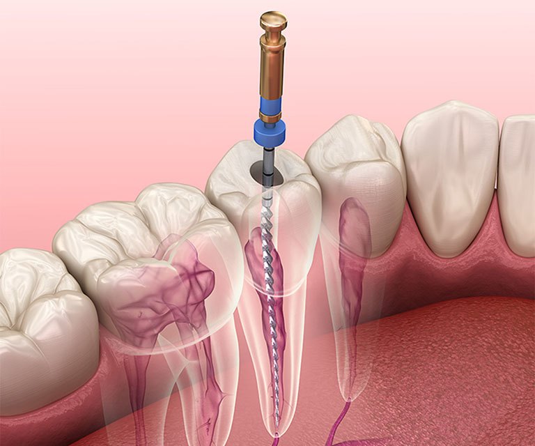 Với trường hợp lấy tủy răng không sạch lần đầu, có thể lấy phần tủy còn sót lần nữa nếu vật liệu hàn trám chưa cứng