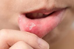 Bị nhiệt miệng tái đi tái lại nhiều lần gây ảnh hưởng nhiều đến sức khỏe và chất lượng cuộc sống của người bệnh