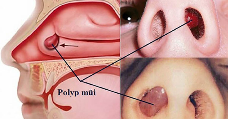 polyp mũi