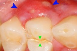 Sưng nướu răng có mủ có thể do nhiều nguyên nhân gây ra