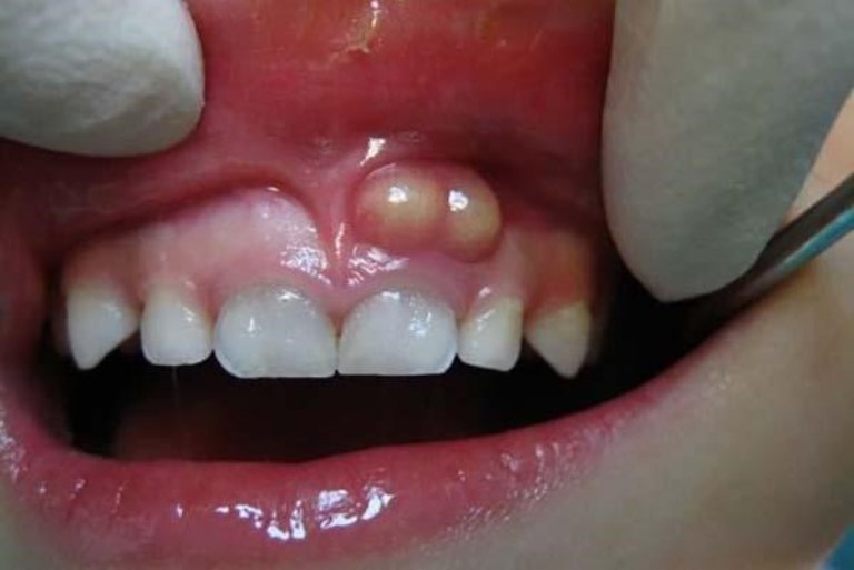 Khi bị áp xe răng, nướu răng cũng bị sưng và có đốm mủ 