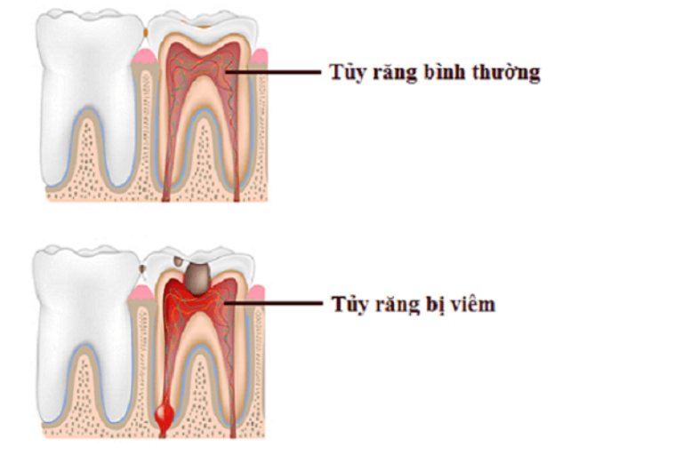 Sự khác nhau giữa tủy răng bình thường và tủy răng bị viêm