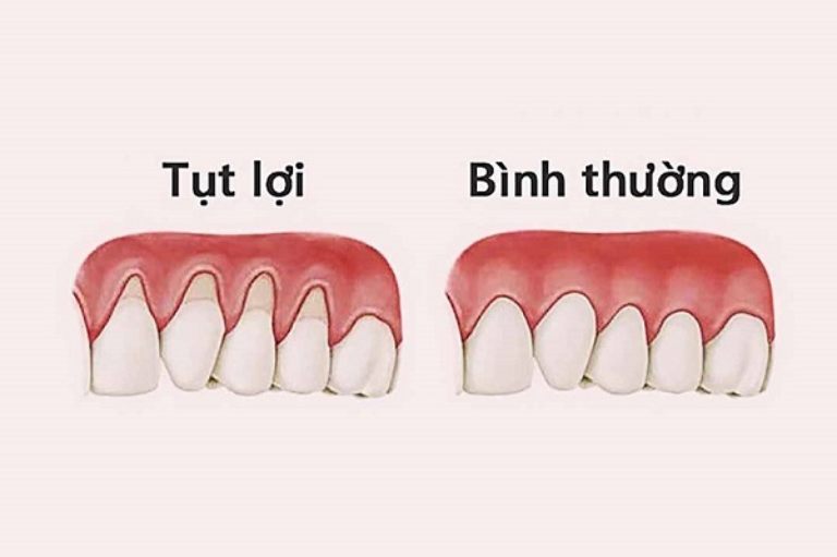 Phân biệt để nhận biết giữa lợi bị tụt và lợi bình thường