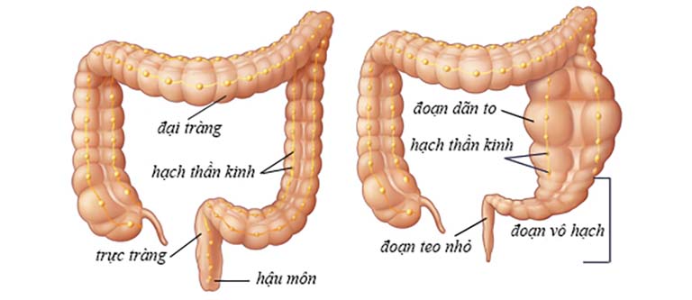 phình đại tràng