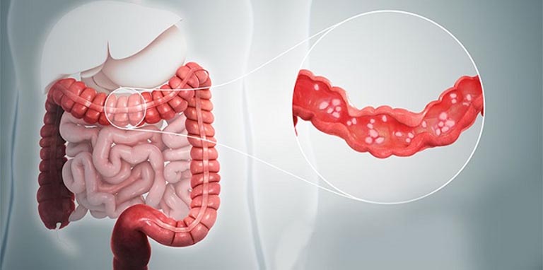 vi khuẩn C. difficile gây bệnh viêm đại tràng