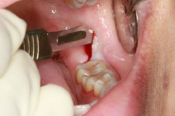 Viêm lợi trùm có mủ thường liên quan đến quá trình mọc của răng khôn