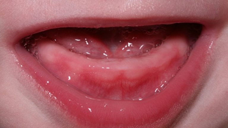 Mọc răng cũng có thể là nguyên nhân khiến trẻ bị viêm lợi trùm 