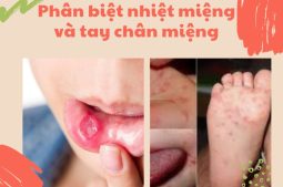 Cần phân biệt nhiệt miệng và tay chân miệng để có biện pháp can thiệp, điều trị kịp thời