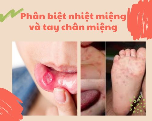 Cần phân biệt nhiệt miệng và tay chân miệng để có biện pháp can thiệp, điều trị kịp thời