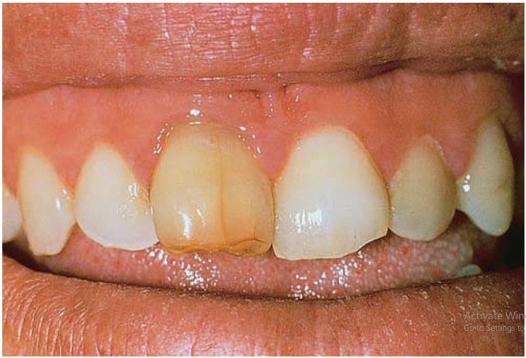 Chiếc răng lấy tủy sau một thời gian thường có màu sắc khác biệt so với những răng khác