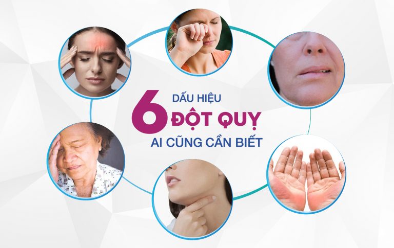 Nên nắm được các dấu hiệu của đột quỵ để sớm nhận biết căn bệnh này