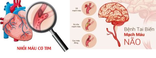 Nhồi máu cơ tim và đột quỵ thường dễ bị nhầm lẫn với nhau