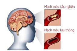 Tắc nghẽn mạch máu não xảy ra rất phổ biến, thường có liên quan đến mảng xơ vữa động mạch