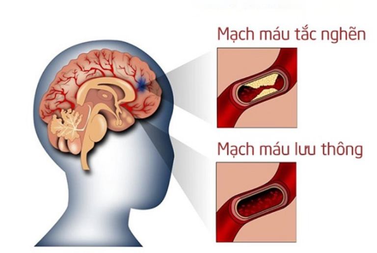 Tắc nghẽn mạch máu não xảy ra rất phổ biến, thường có liên quan đến mảng xơ vữa động mạch