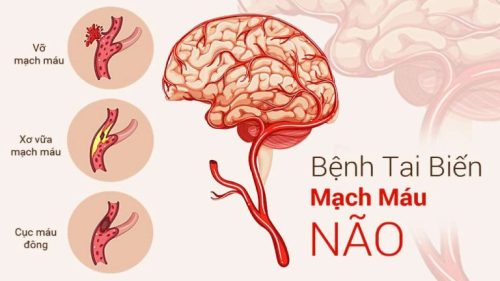 Đột quỵ hay tai biến mạch máu não là bệnh lý vô cùng nguy hiểm, xảy ra hết sức đột ngột