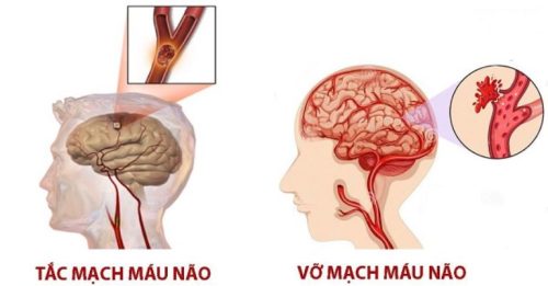 Tai biến mạch máu não là bệnh lý xảy ra khi gián đoạn lưu thông máu đến não do tắc hoặc vỡ mạch máu não